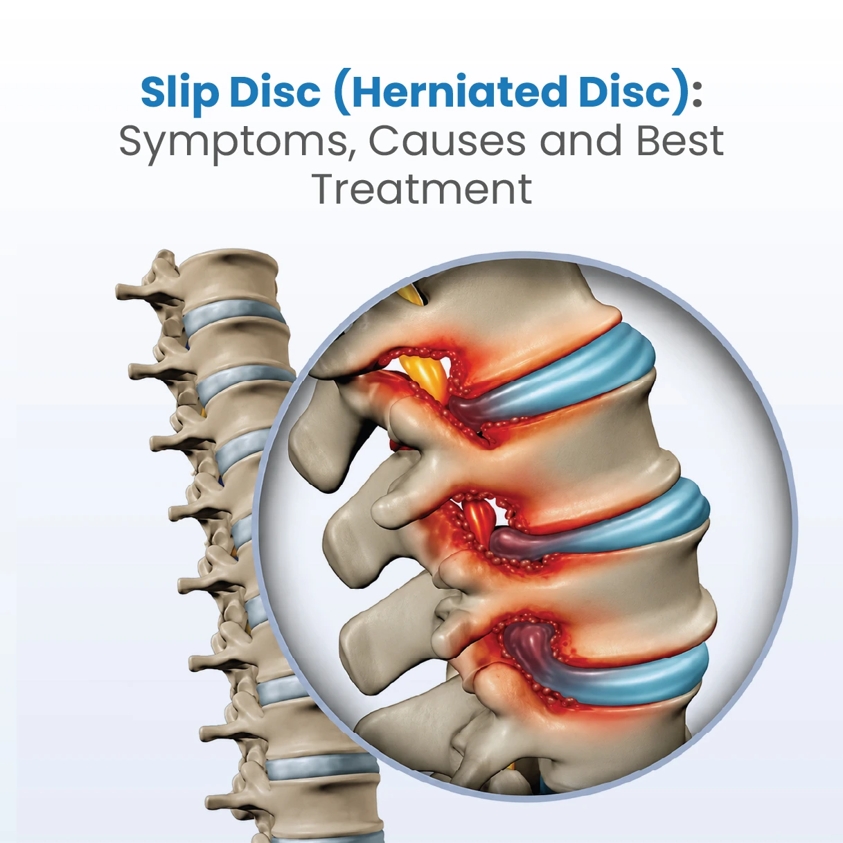 Slip Disc (Herniated Disc): Symptoms, Causes & Treatment Options